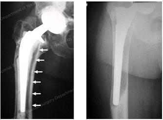 hip_prosthesis_implant_loose_xray.jpg